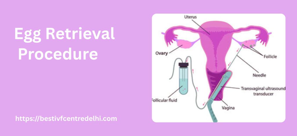 Egg-Retrieval-Procedure