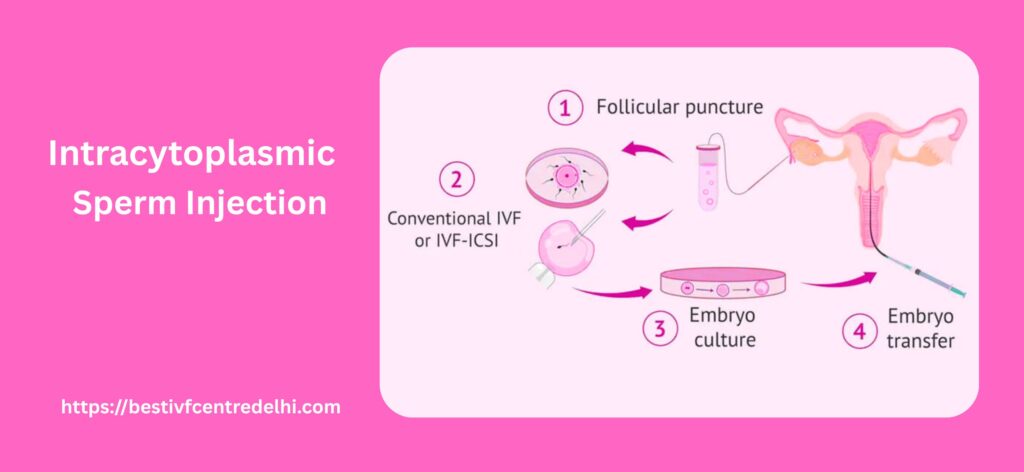 Intracytoplasmic Sperm Injection